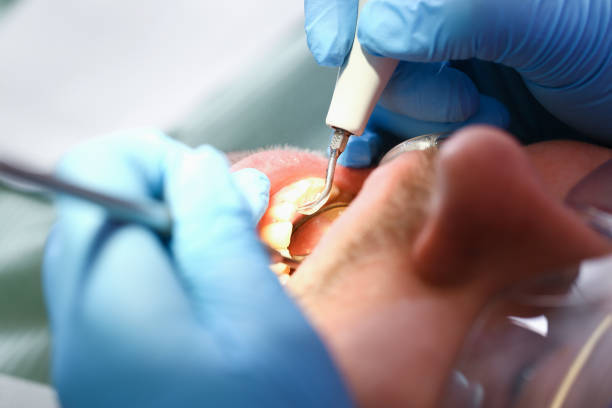 Best Emergency Wisdom Teeth Removal in Island Lake, IL