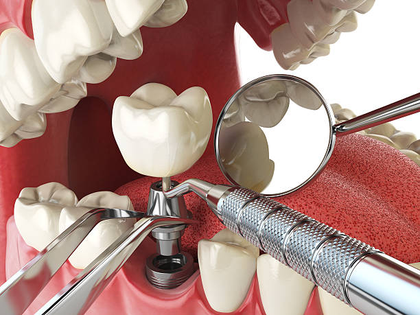Best Emergency Wisdom Teeth Removal in Island Lake, IL